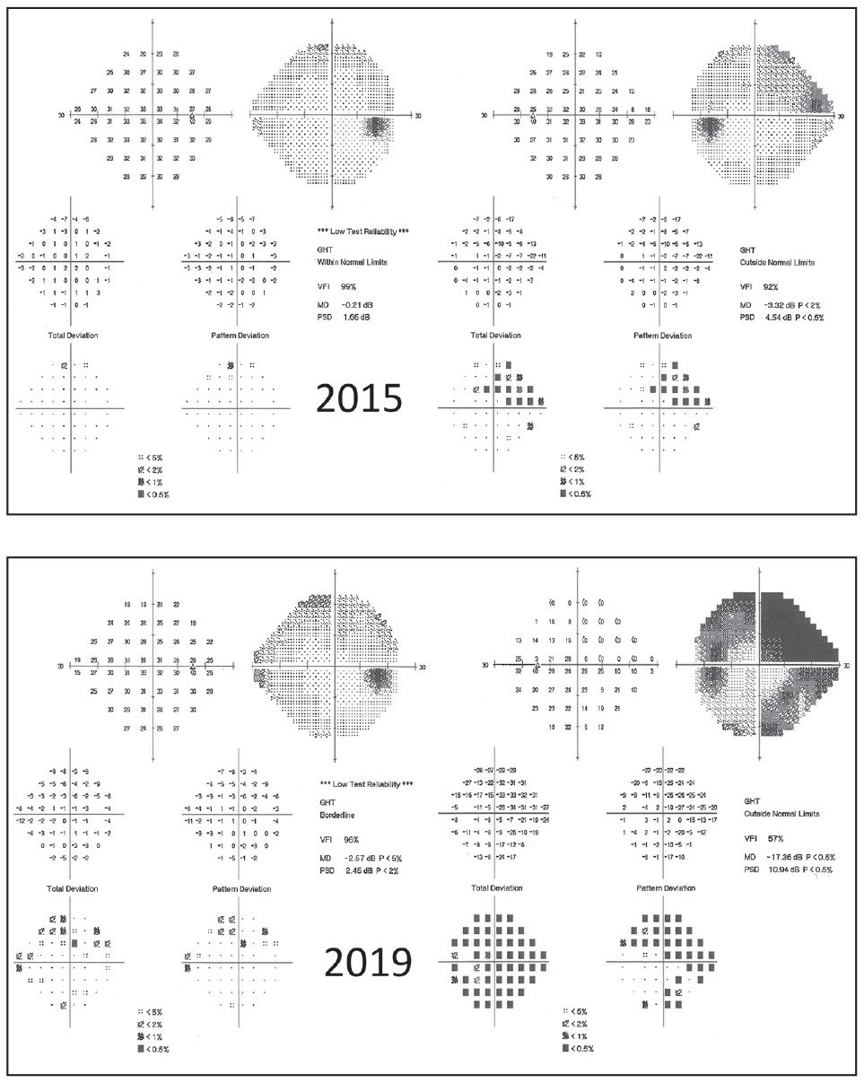 Trend Analysis Might Underestimate Severe Glaucoma Progression Rates